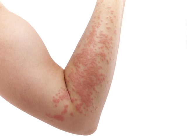 Skin Allergy Rash